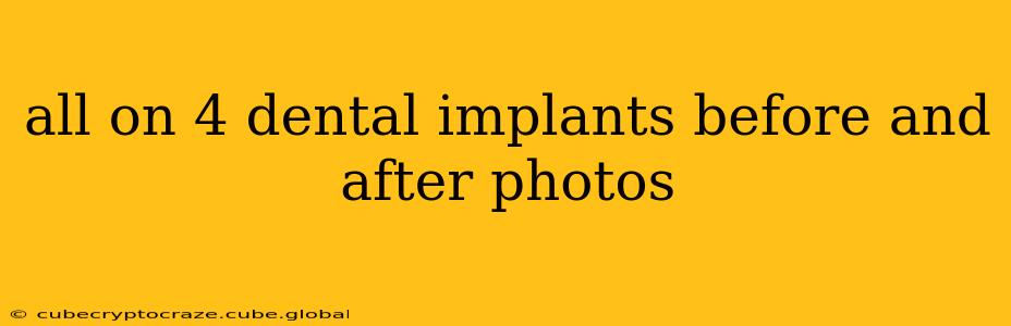 all on 4 dental implants before and after photos