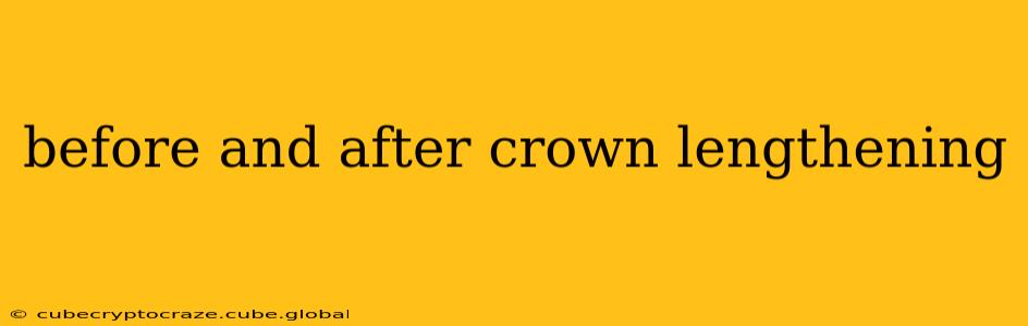 before and after crown lengthening