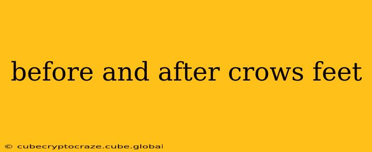 before and after crows feet