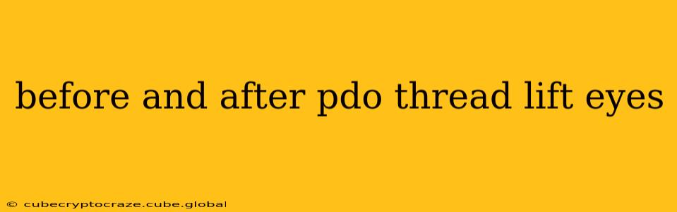 before and after pdo thread lift eyes