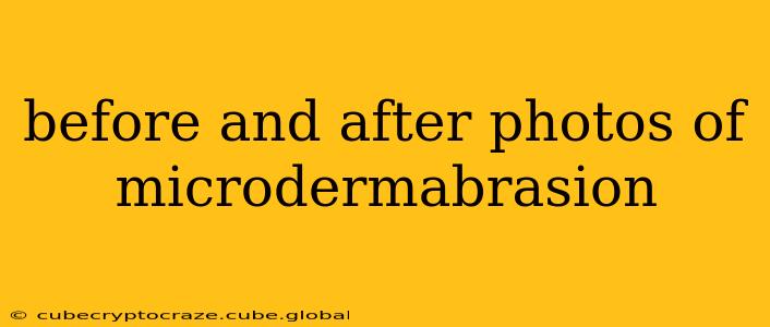 before and after photos of microdermabrasion