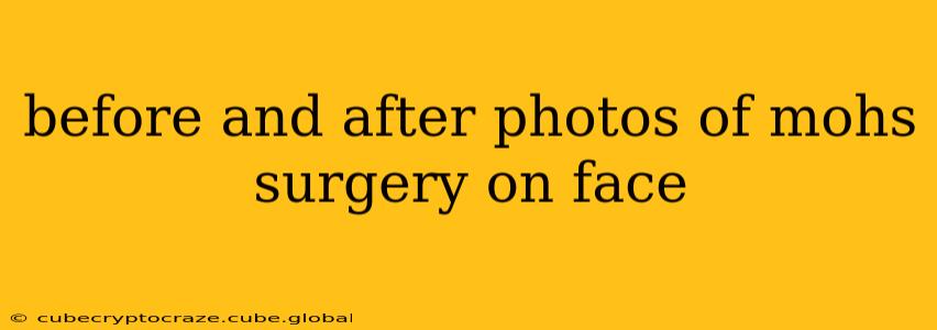 before and after photos of mohs surgery on face
