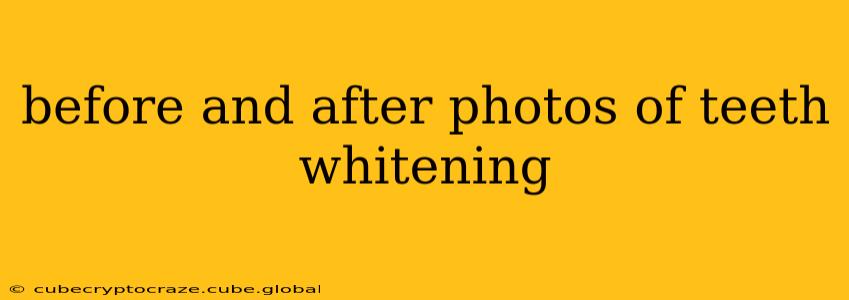 before and after photos of teeth whitening