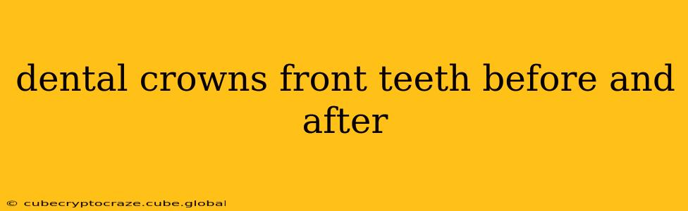 dental crowns front teeth before and after