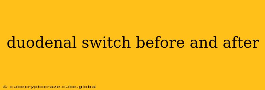 duodenal switch before and after