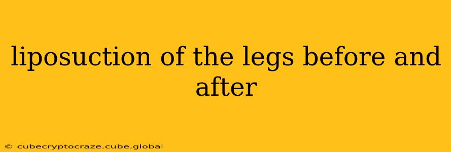 liposuction of the legs before and after