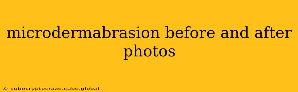 microdermabrasion before and after photos