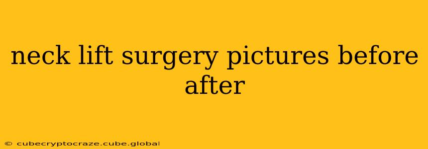 neck lift surgery pictures before after