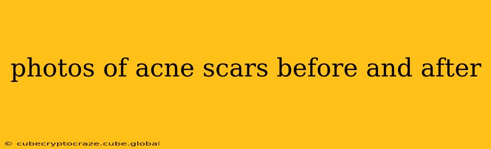 photos of acne scars before and after