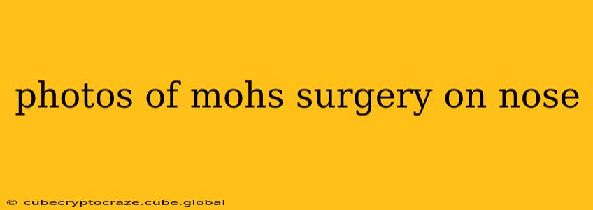 photos of mohs surgery on nose