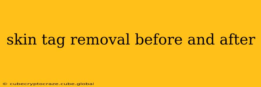 skin tag removal before and after