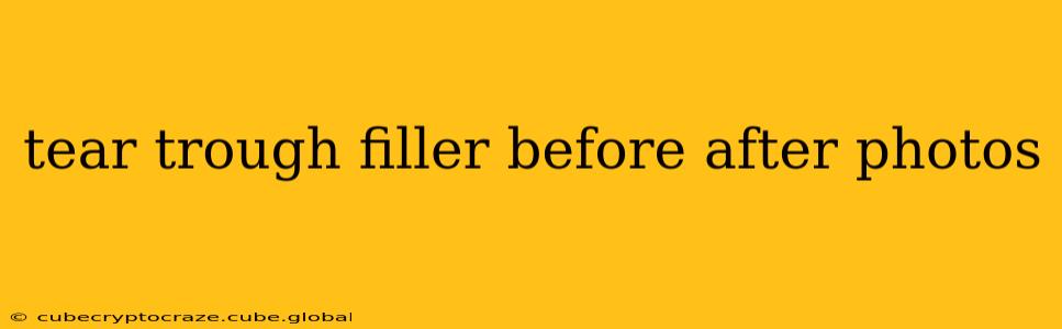 tear trough filler before after photos