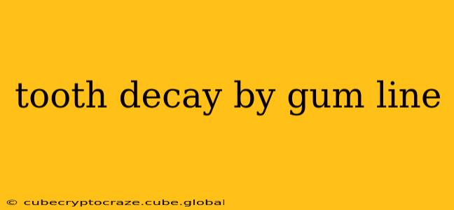 tooth decay by gum line